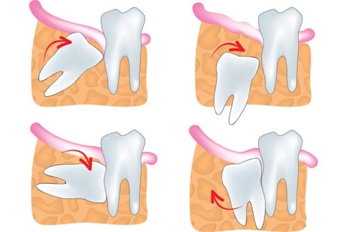 Tại sao nên nhổ răng khôn mọc lệch? Những hậu quả của việc không nhổ.
