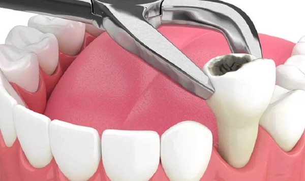 Tại sao nên nhổ răng khôn mọc lệch? Những hậu quả của việc không nhổ.