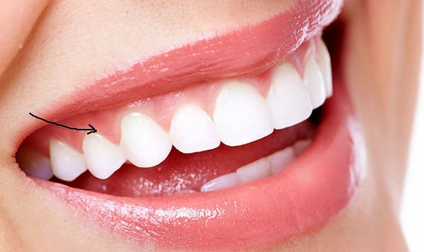 Cách bảo vệ nướu sau khi lấy cao răng