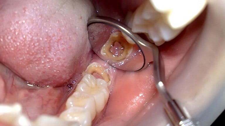 Cách lựa chọn địa chỉ nhổ răng khôn uy tín tại TP.HCM.