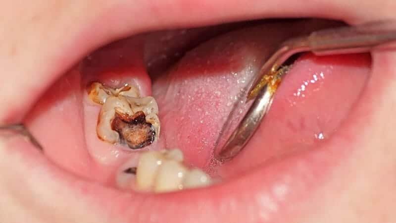 Địa chỉ nhổ răng khôn uy tín và an toàn tại quận Phú Nhuận.