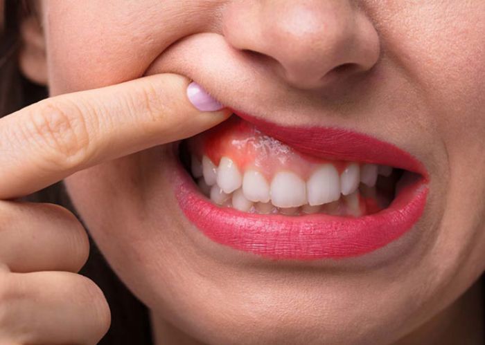 Cách bảo vệ nướu sau khi lấy cao răng