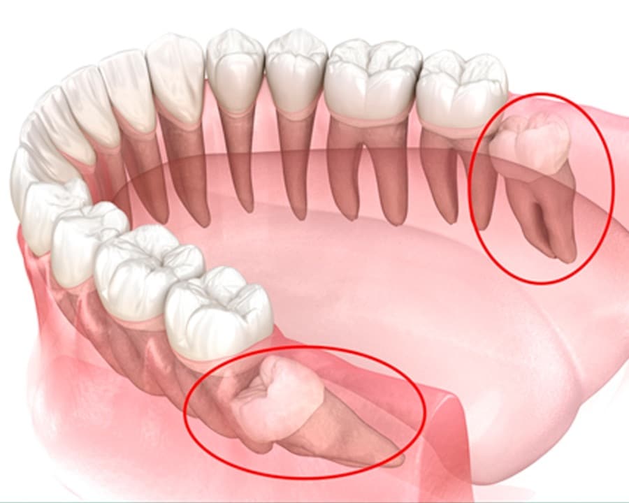 Răng khôn mọc thẳng có nên nhổ không? Khi nào cần xem xét việc nhổ răng khôn.