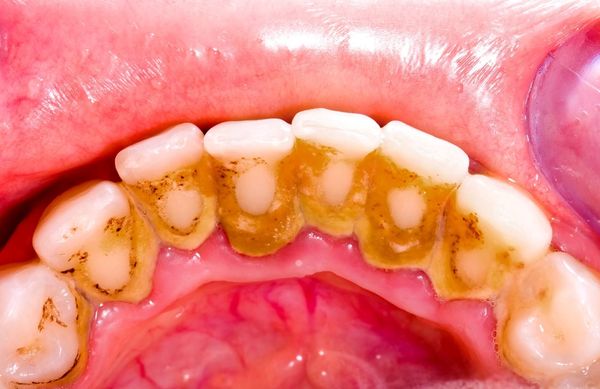 Mới lấy cao răng nên uống gì để giữ cho răng miệng sạch sẽ?