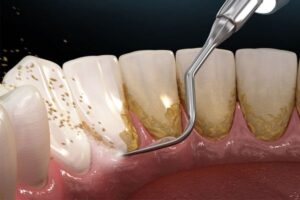 giá lấy cao răng ở Bình Thạnh