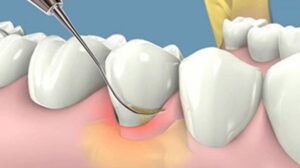 Lấy cao răng tại Bình Thạnh