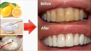 dụng cụ lấy cao răng tại nhà