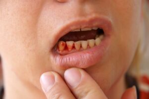 Lấy cao răng có chảy máu không