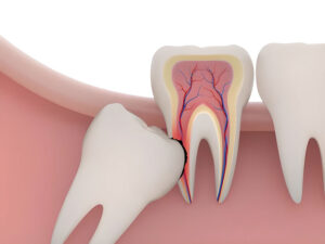 biến chứng thường gặp sau khi nhổ răng khôn