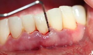 Lấy cao răng có chảy máu không