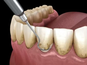lấy cao răng có hại không