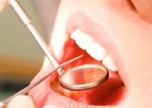 Lấy cao răng tại Bình Thạnh