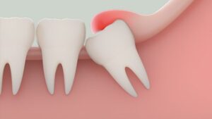 Tại sao nhổ răng khôn hàm dưới có nguy cơ biến chứng cao hơn hàm trên? 1 nhổ răng khôn hàm dưới