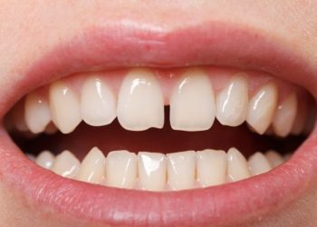 Lấy cao răng có làm răng bị thưa không?