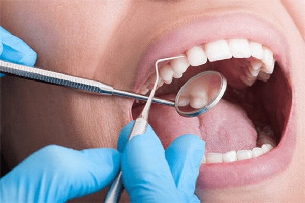 Lấy cao răng có mất nhiều thời gian không? Cách tối ưu quy trình lấy cao răng 3 Cách tối ưu thời gian lấy cao răng, tiết kiệm thời gian