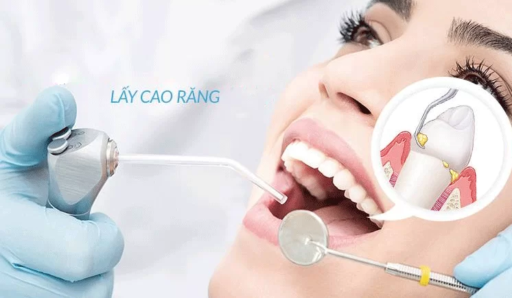 Lấy cao răng có mất nhiều thời gian không? Cách tối ưu quy trình lấy cao răng 1 Lấy cao răng có mất nhiều thời gian không?