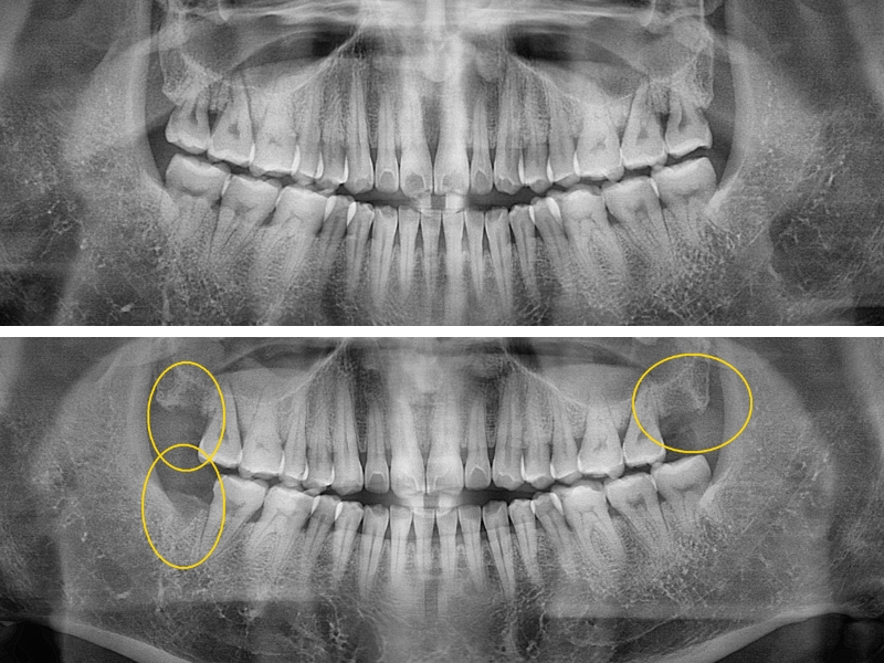 Hình ảnh trước khi nhổ răng khôn