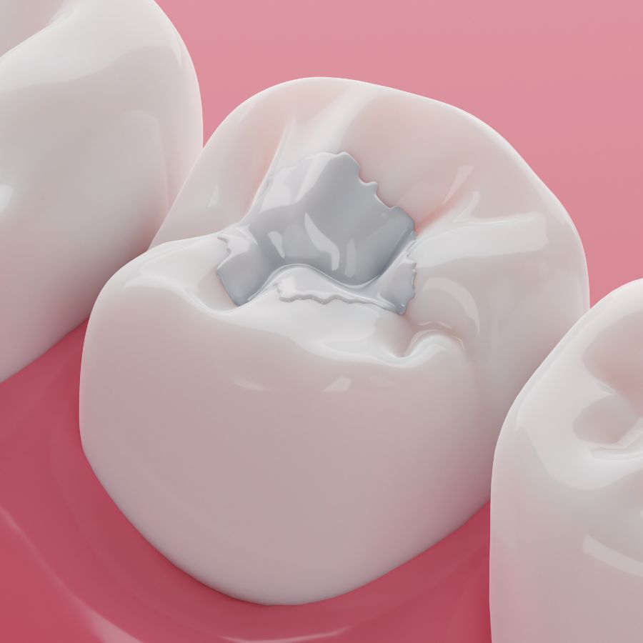 Yếu Tố Tác Động Đến Bảng Giá Trám Răng Thẩm Mỹ