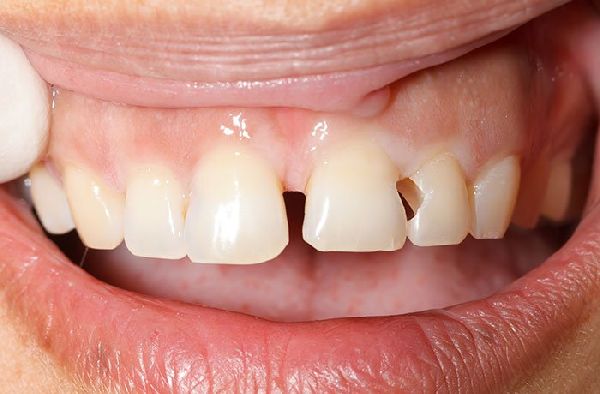 Khi Nào Cần Trám Răng Cửa Bị Sâu?