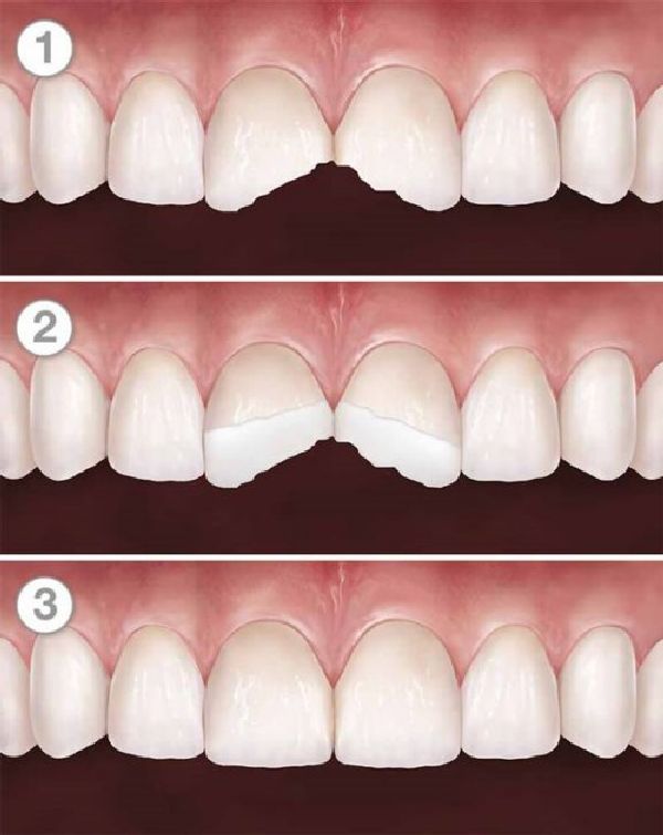 Chi Phí Trám Răng Bị Mẻ Có Đắt Không?