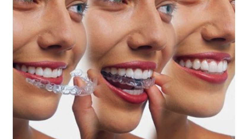 Giá Niềng Răng Invisalign – Yếu Tố Ảnh Hưởng Và Lựa Chọn Phù Hợp 1 Vì sao nhiều người chọn niềng răng Invisalign?