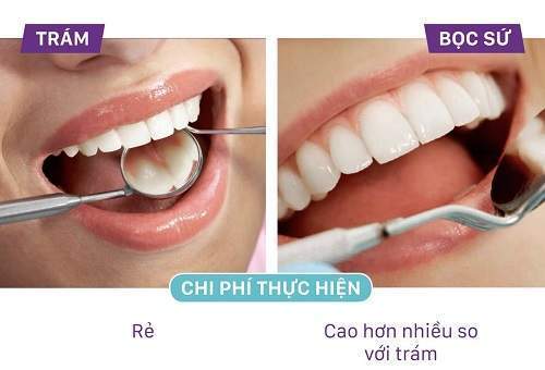 So Sánh Giữa Trám Răng Và Bọc Sứ – Phương Pháp Nào Tốt Hơn?