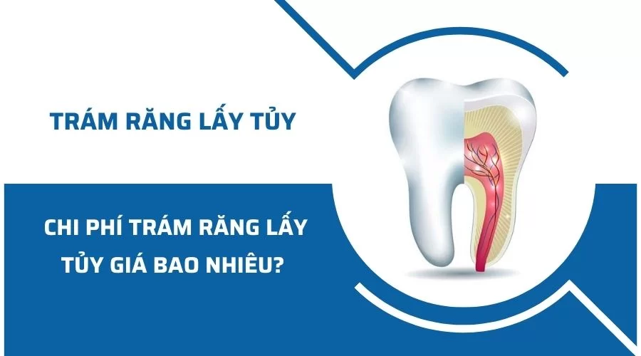 Tram rang lay tuy gia bao nhieu