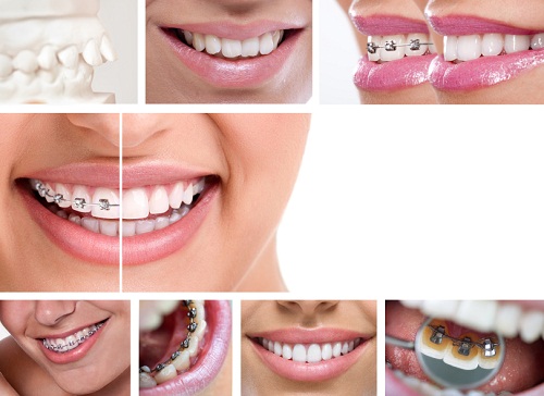 Tại sao nên niềng răng tại HCM?