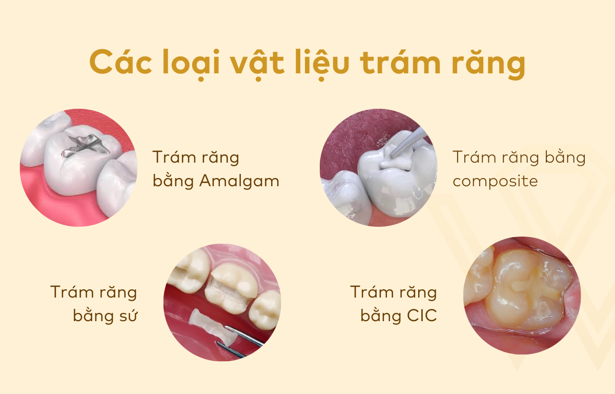 Các Loại Vật Liệu Trám Răng Cửa Phổ Biến