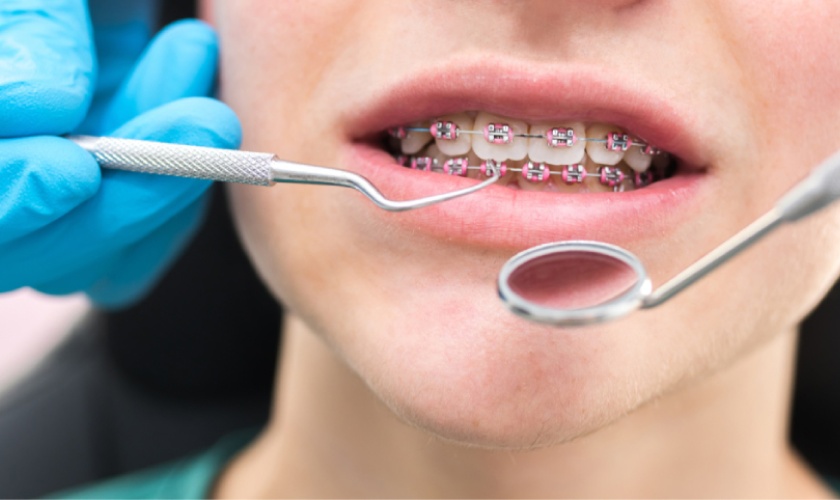 Niềng răng ở đâu tốt tại TP.HCM?