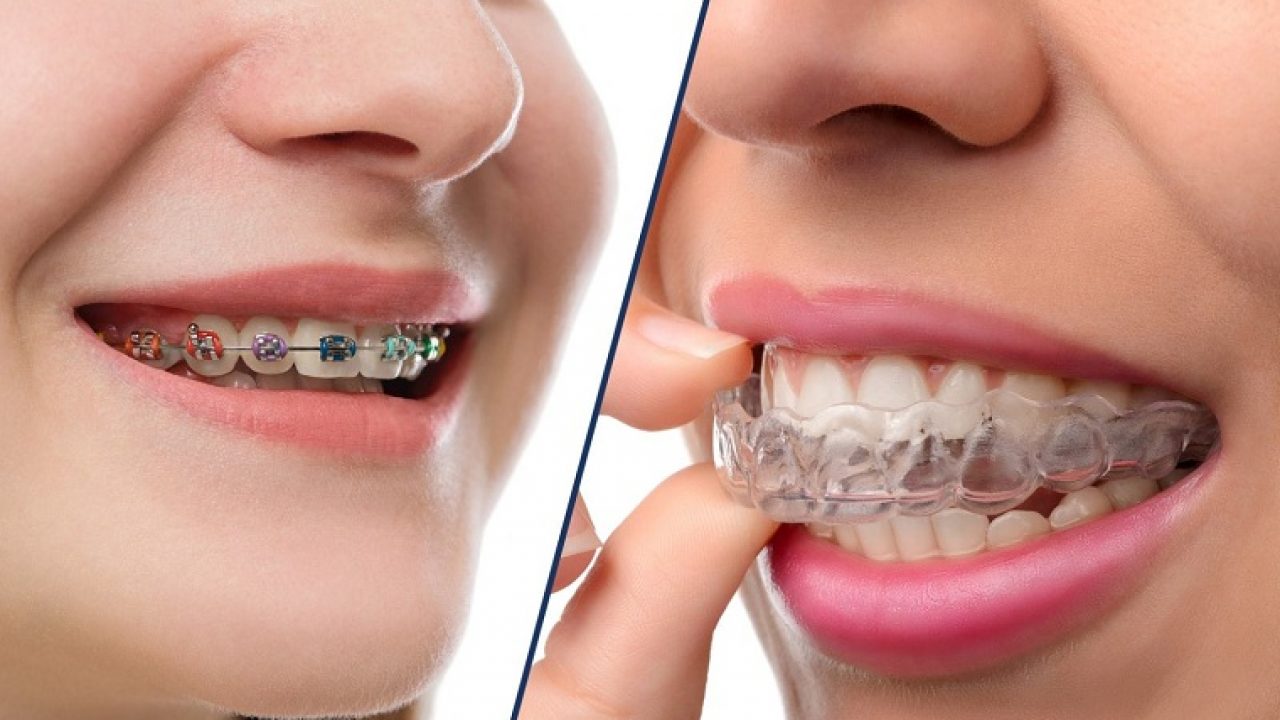 So sánh Invisalign và niềng răng mắc cài truyền thống