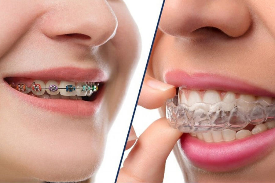 Tổng Quan Về Niềng Răng Ở Đại Học Y Dược TP HCM