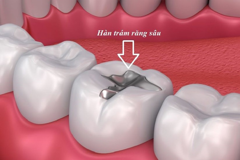 Chi Phí Hàn Trám Răng Sâu Có Đắt Không? Những Yếu Tố Ảnh Hưởng Đến Giá 3 Những Yếu Tố Ảnh Hưởng Đến Chi Phí Hàn Trám Răng Sâu
