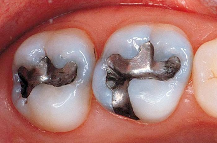 Chi Phí Hàn Trám Răng Sâu Có Đắt Không? Những Yếu Tố Ảnh Hưởng Đến Giá 2 Chi Phí Hàn Trám Răng Sâu Có Đắt Không?