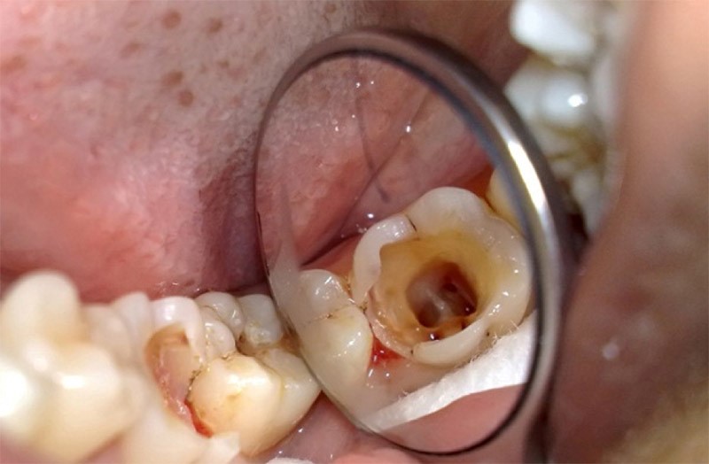 Trám Răng Lấy Tủy Là Gì? Khi Nào Cần Thực Hiện?