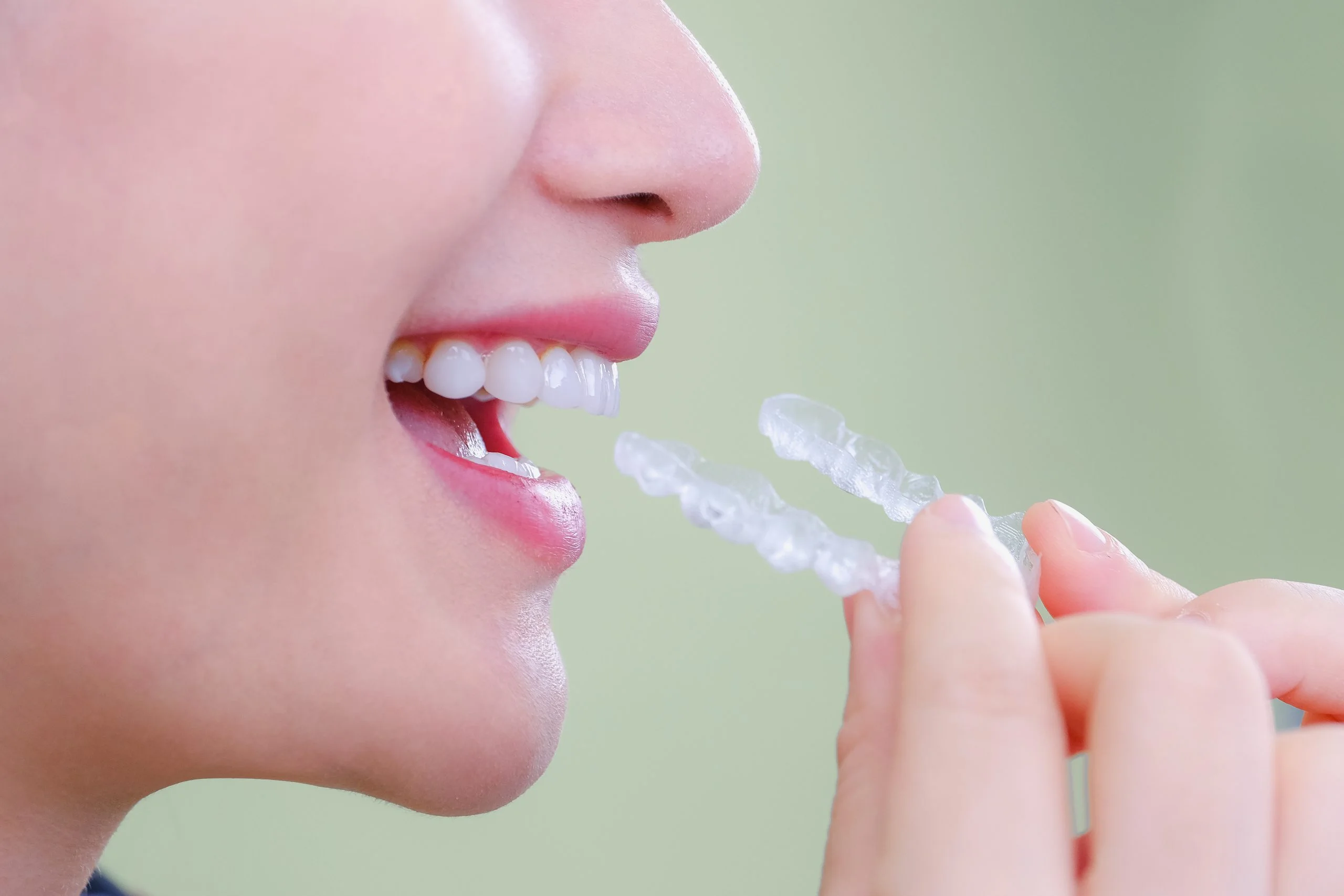 Thoải mái, tự tin hơn khi niềng răng