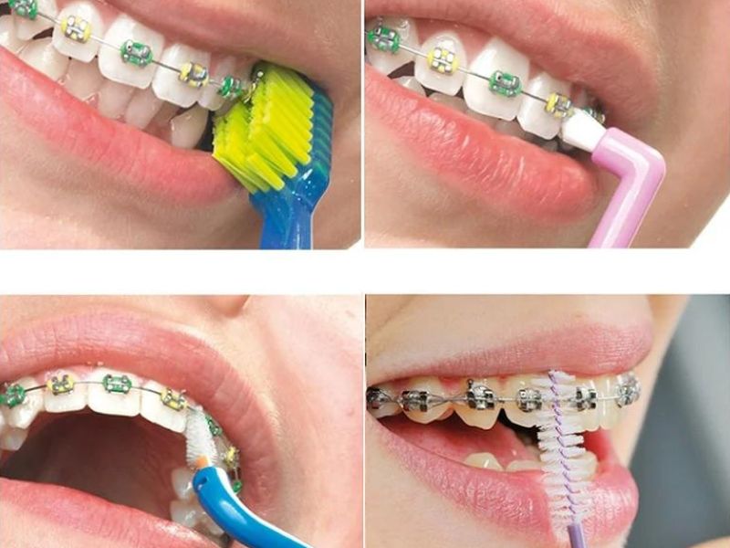 Có Nên Niềng Răng Ở Đại Học Y Dược TP HCM?