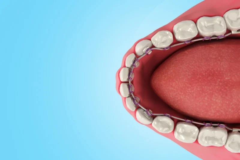 Niềng Răng Mặt Lưỡi Là Gì? Khác Gì So Với Niềng Truyền Thống?