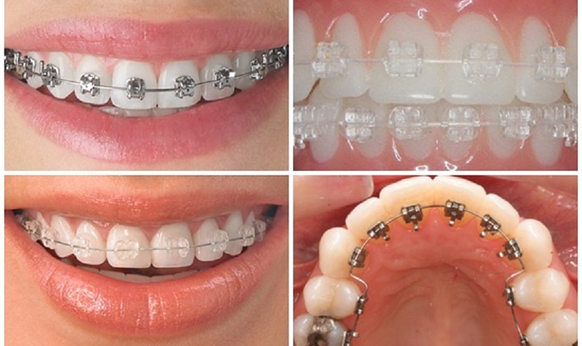 Các phương pháp niềng răng phổ biến tại TP.HCM