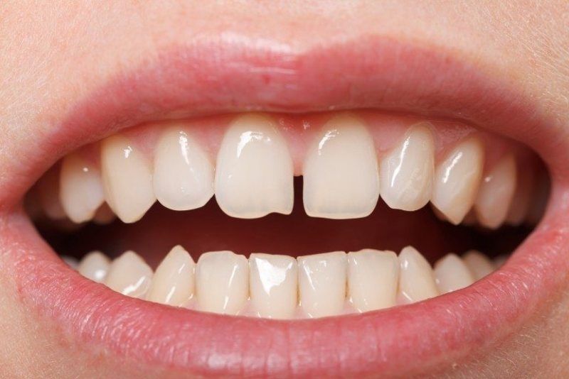 Giá Trám Răng Cửa Thưa Bao Nhiêu Tiền?