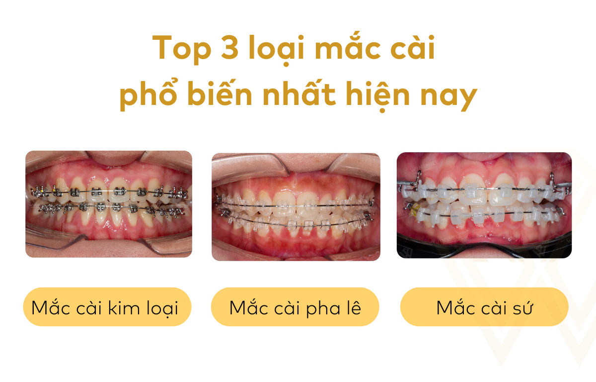 Chi Phí Niềng Răng Ở Đại Học Y Dược TP HCM Có Cao Không?