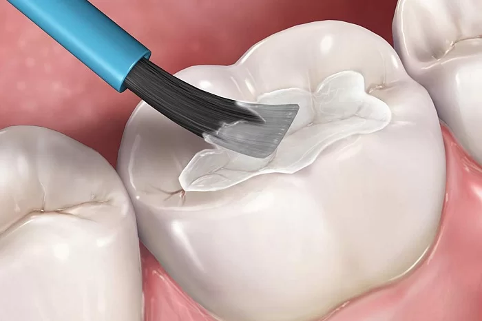 Chi Phí Hàn Trám Răng Sâu Có Đắt Không? Những Yếu Tố Ảnh Hưởng Đến Giá 1 Hàn Trám Răng Sâu Là Gì? Ai Nên Thực Hiện?