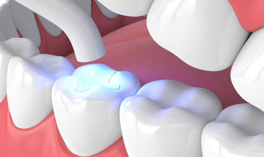 Bảng Giá Trám Răng Thẩm Mỹ Mới Nhất Hiện Nay