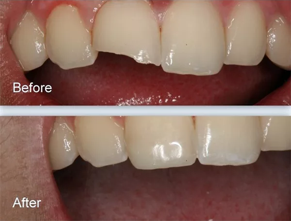 Răng Mẻ Có Trám Được Không? Câu Trả Lời Chính Xác