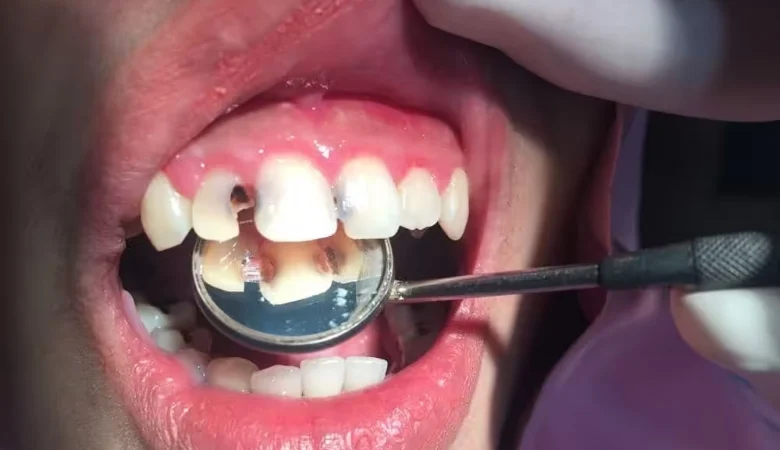 Giá Trám Răng Cửa Bị Sâu Bao Nhiêu Tiền?