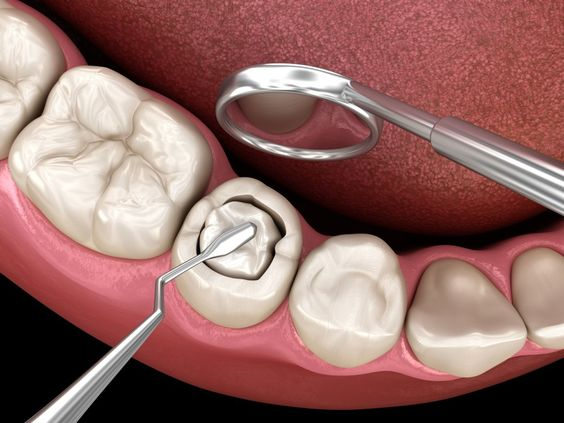 Trám Răng Sau Chữa Tủy Có Bền Không? Lưu Ý Gì Sau Khi Thực Hiện?