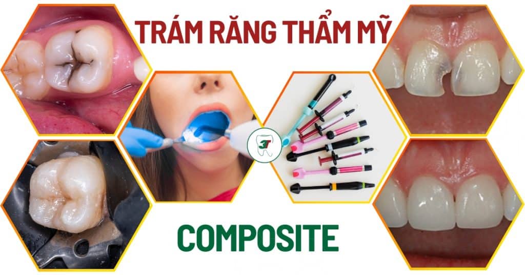 Vật liệu trám răng phổ biến