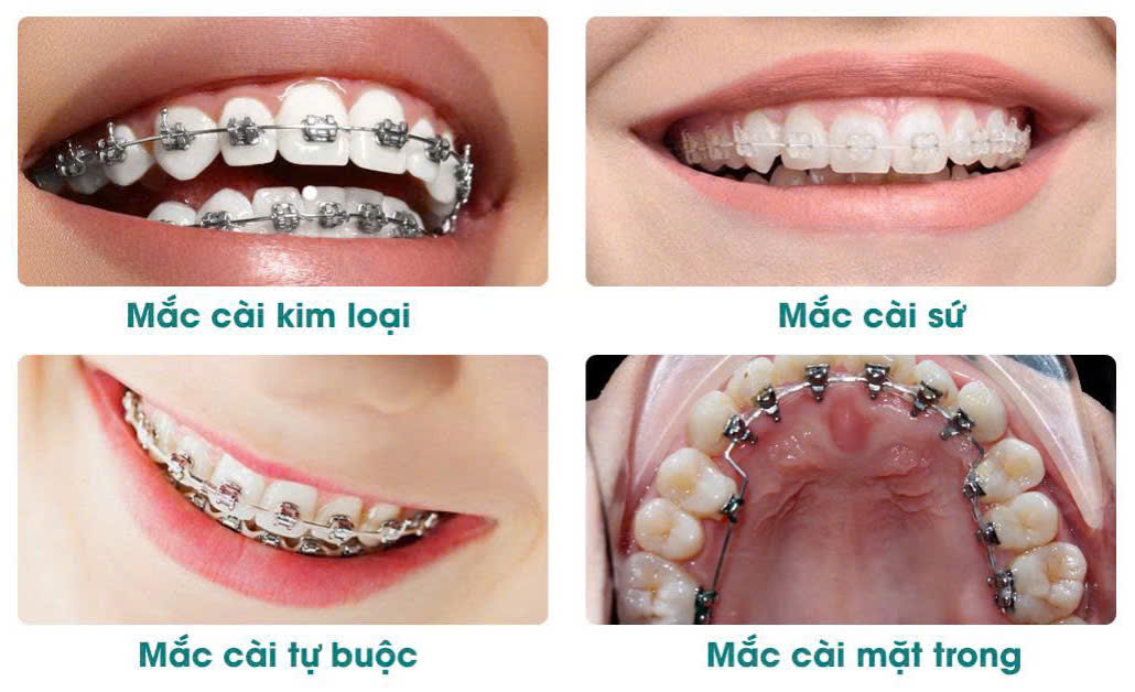 Niềng Răng Mắc Cài Mặt Lưỡi Giá Bao Nhiêu? Cập Nhật Bảng Giá Mới Nhất 5 So sánh chi phí với các phương pháp khác