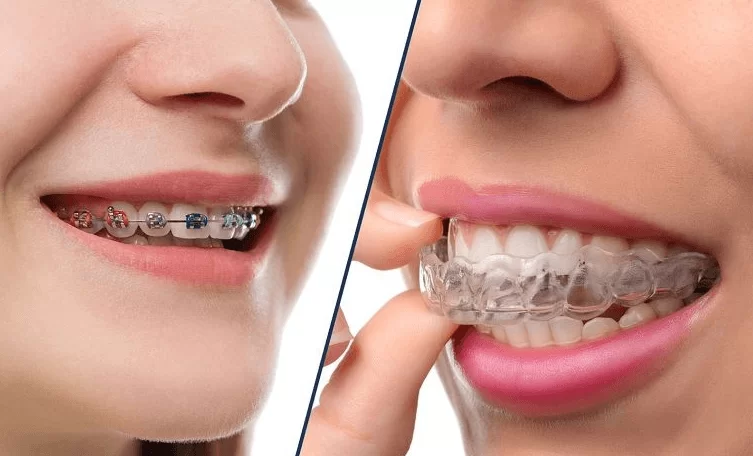 Niềng Răng Là Gì? Tại Sao Nên Niềng Răng?