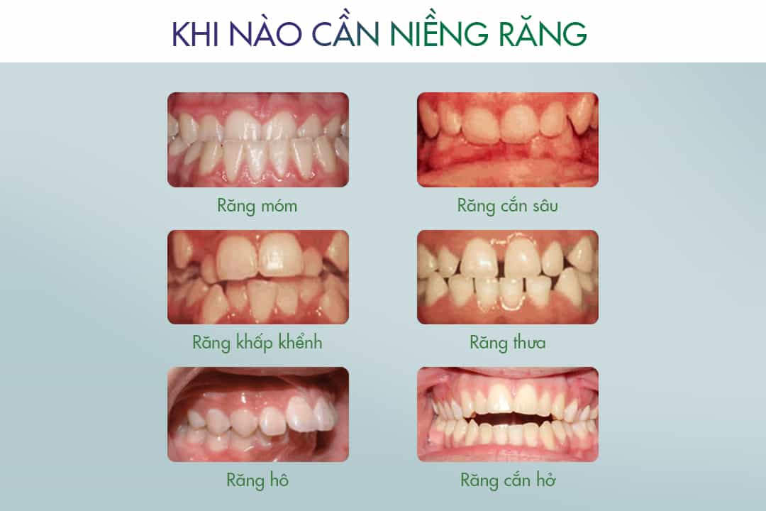 Tình Trạng Răng Nào Cần Niềng Răng?